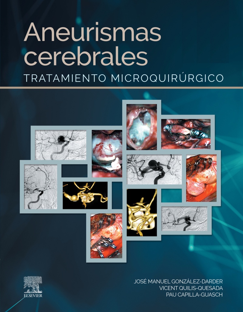 ANEURISMAS CEREBRALES-ISBN:9788491138853